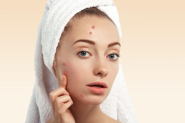 Pimple Patches